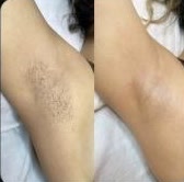 Axilas antes e depois