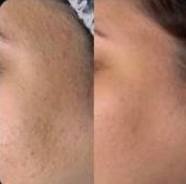 Pele do rosto antes e depois do tratamento