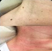 Remoção de sinais, antes e depois